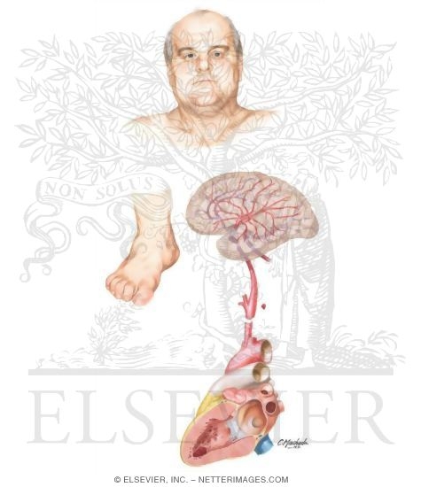 Face of Obese Man
Foot: Diminished Circulation
Arteries of Brain
Heart: Cross Section