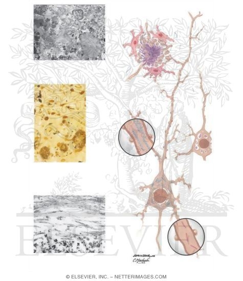 Watermarked preview of unlabeled image: Microscopic Pathology In Alzheimer's Disease