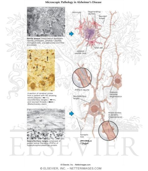 Watermarked preview of labeled image: Microscopic Pathology In Alzheimer's Disease
