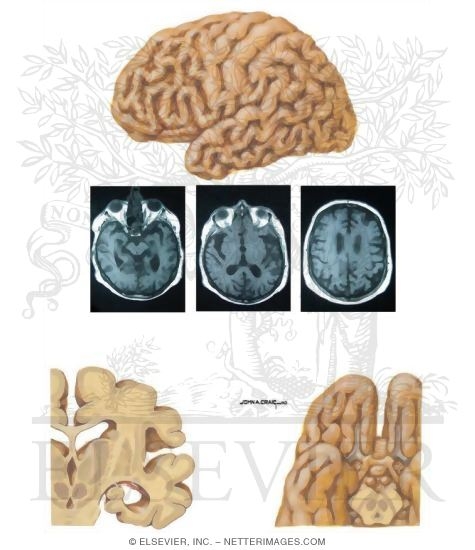 Watermarked preview of unlabeled image: Gross Pathology in Alzheimer's Disease