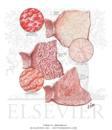 Watermarked preview of labeled image: Gastritis