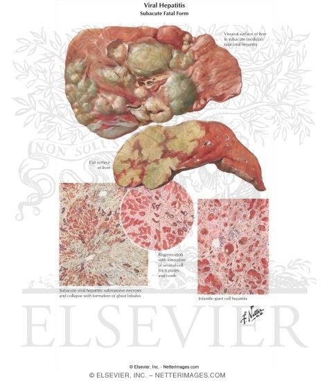 Watermarked preview of labeled image: Viral Hepatitis III - Subacute Fatal Form