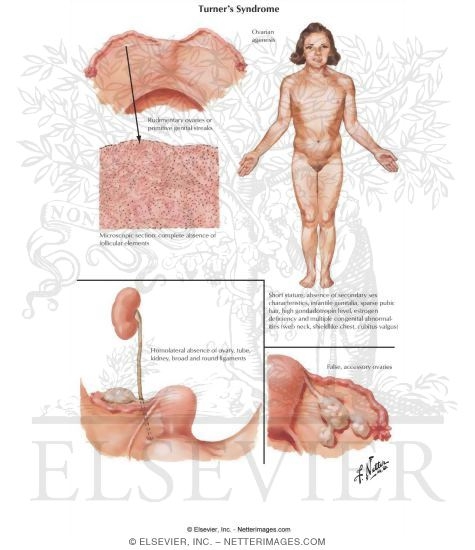 Turner's Syndrome