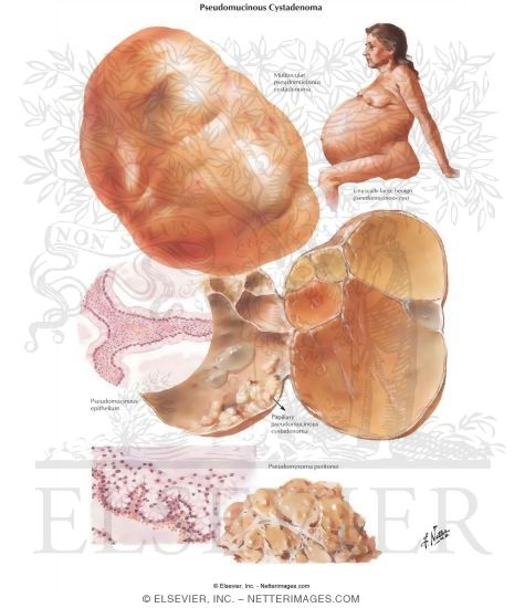 Pseudomucinous Cystadenoma
