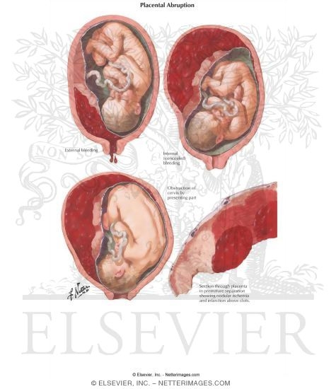 Placental Abruption