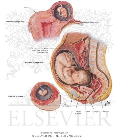 Ectopic Pregnancy Iii Interstitial Abdominal Ovarian