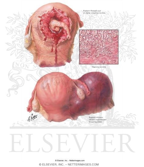 Watermarked preview of labeled image: Rupture of Uterus