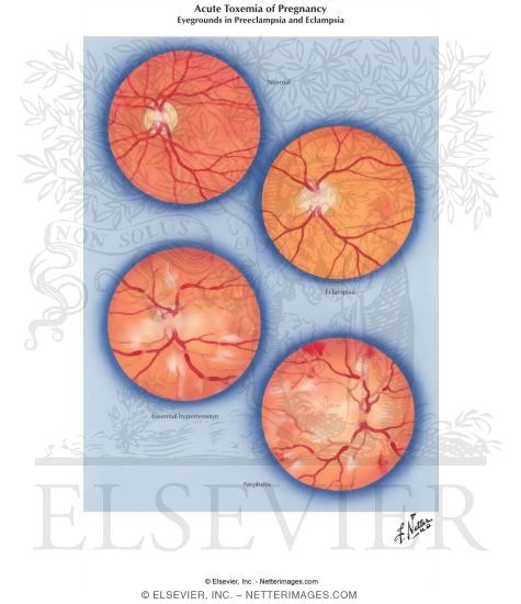 Acute Toxemia of Pregnancy II - Eyegrounds in Preeclampsia and Eclampsia