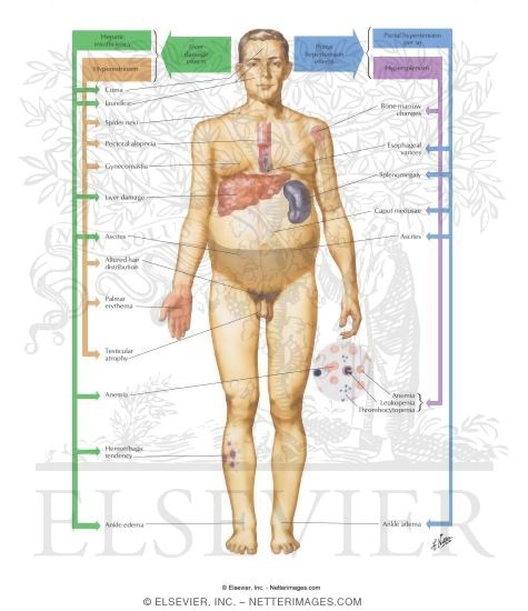 Cirrhosis III - Clinical Manifestations