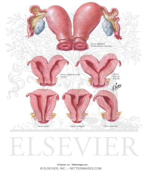 Uterine Anomalies: Bicornuate, Septate, and Unicornuate Uterus