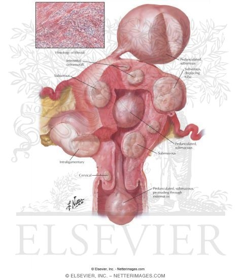 Watermarked preview of labeled image: Myoma (Fibroid) I - Locations