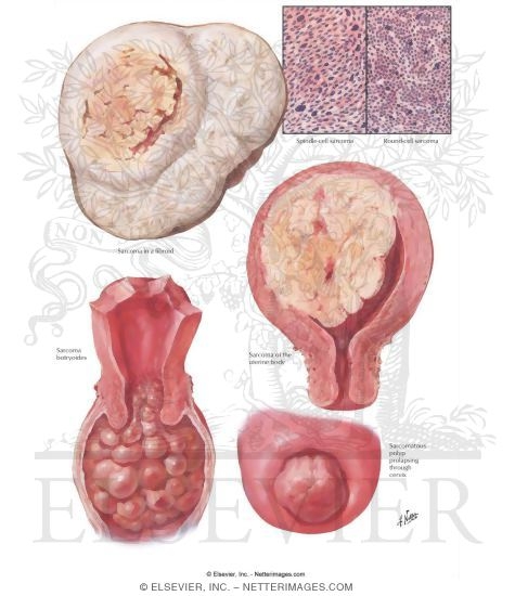 Watermarked preview of labeled image: Sarcoma Botryoides