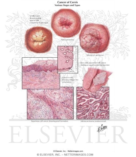 Cancer of Cervix II - Various Stages and Types