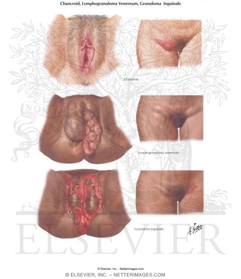 Chancroid, Lymphogranuloma Venereum, Granuloma Inguinale