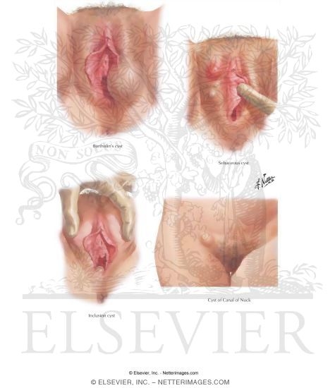 lesions on vulva The labyrinth porn