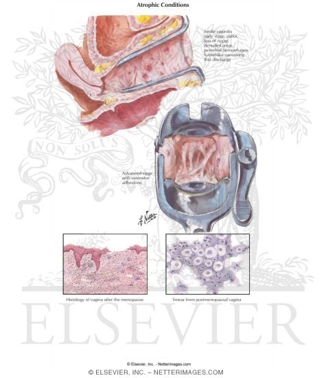 Watermarked preview of labeled image: Atrophic Conditions
Vaginal Dryness