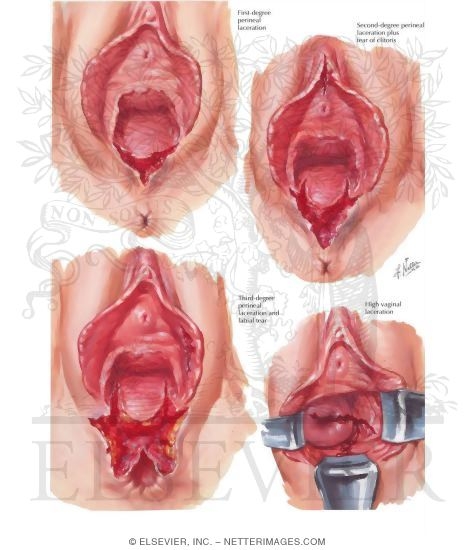Obstetric Lacerations II - Vagina, Perineum, Vulva
Vaginal Lacerations