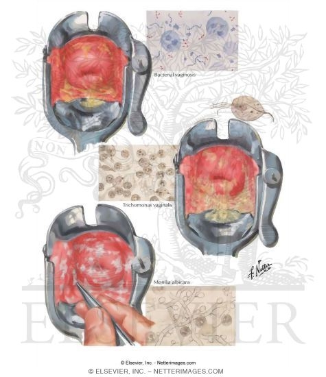 Vaginitis I - Trichomoniasis, Moniliasis, Nonspecific