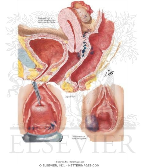 Endometriosis I - Vulva, Vagina, Cervix