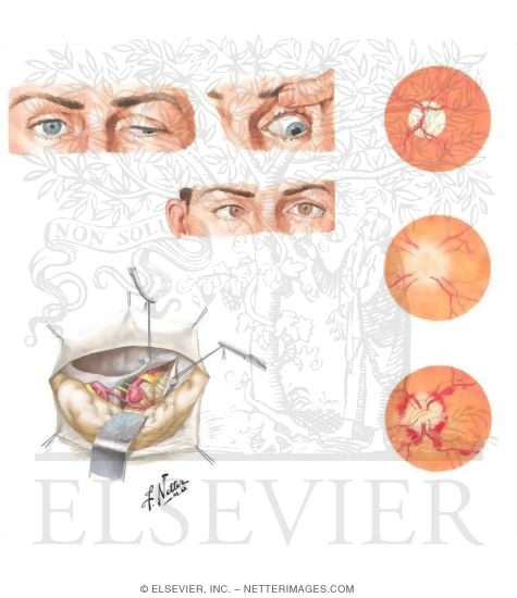Watermarked preview of unlabeled image: Ophthalmologic Manifestations of Cerebral Aneurysms