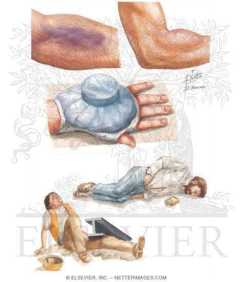 Closed Soft Tissue Injuries