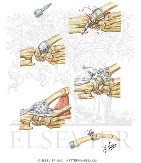 Watermarked preview of unlabeled image: Trapezium Implant Resection Arthroplasty for Thumb Disabilities