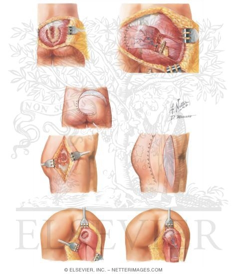 Watermarked preview of unlabeled image: Excision of Deep Pressure Ulcer
