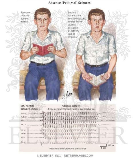 Absence (Petit Mal) Seizures
