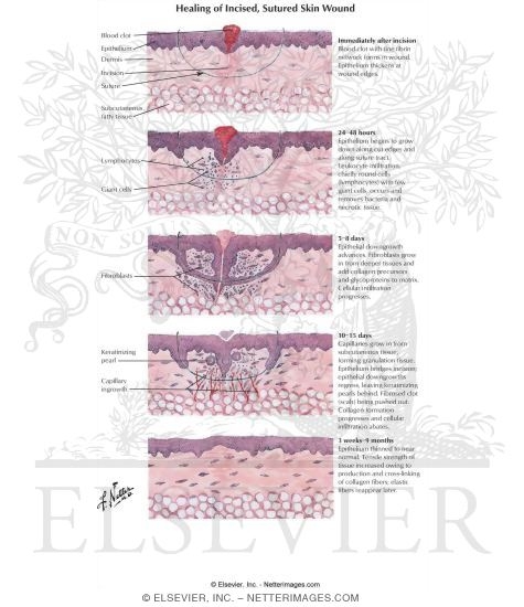 Healing of Incised, Sutured Skin Wound