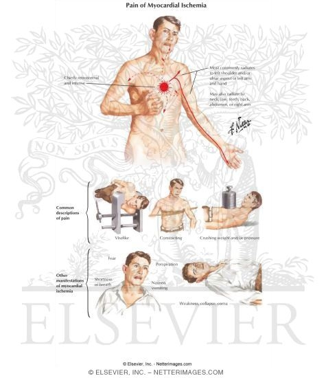 Watermarked preview of labeled image: Pain of Myocardial Ischemia