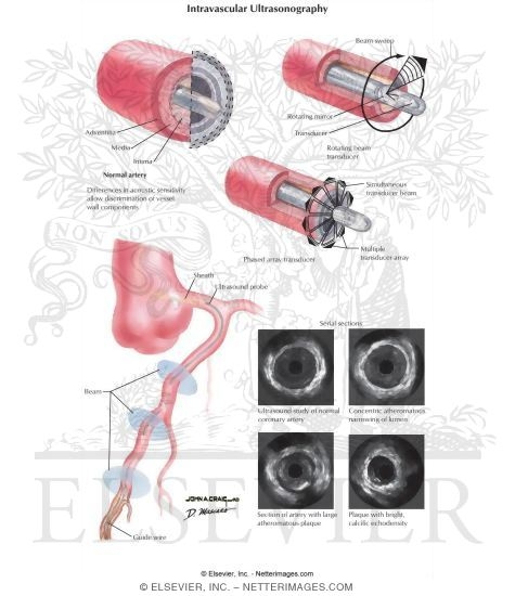 Watermarked preview of labeled image: Intravascular Ultrasonography