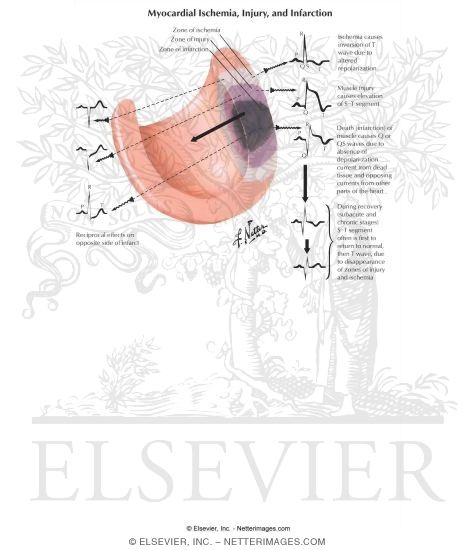 Effect of Cardiac Infarction, Injury, and Ischemia
Myocardial Ischemia, Injury, and Infarction
