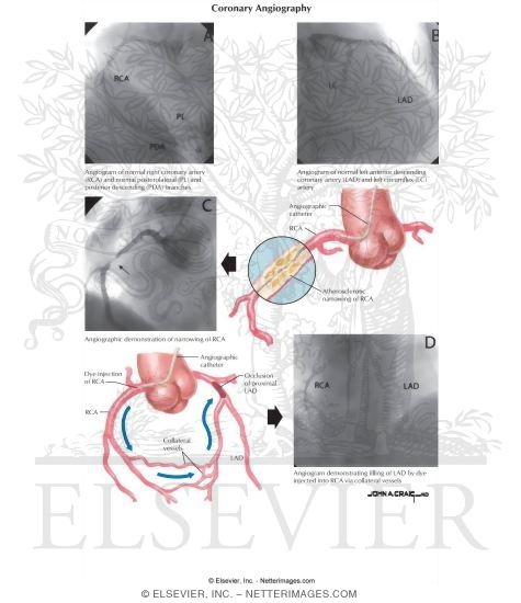 Coronary Angiography