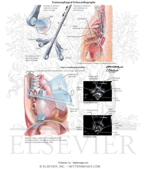 Transesophageal Echocardiography