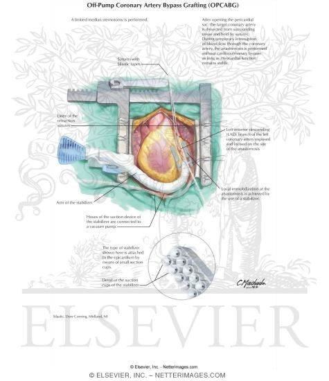 Off-Pump Coronary Artery Bypass Grafting (OPCABG)