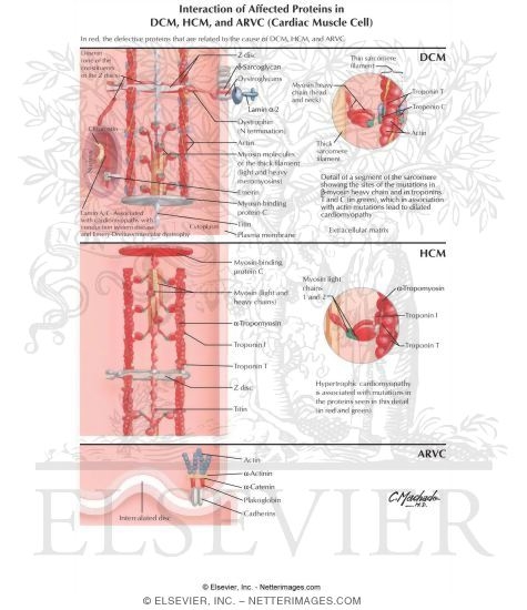 Watermarked preview of labeled image: Interaction of Affected Proteins in DCM, HCM, and ARVC (Cardiac Muscle Cell)