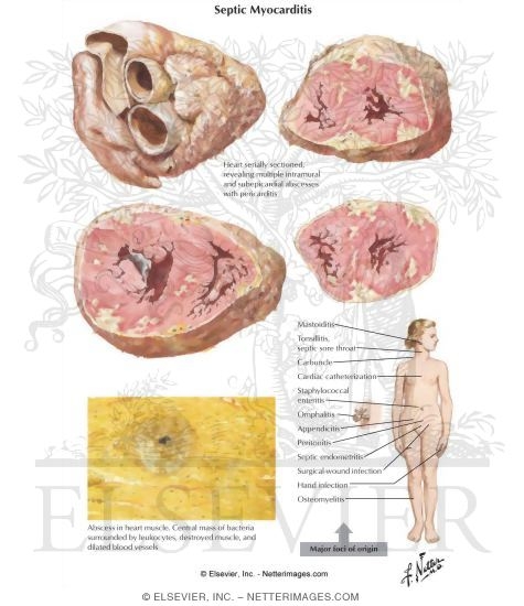 Septic Myocarditis