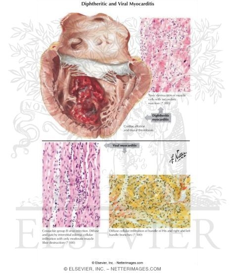 Watermarked preview of labeled image: Diphtheritic and Viral Myocarditis