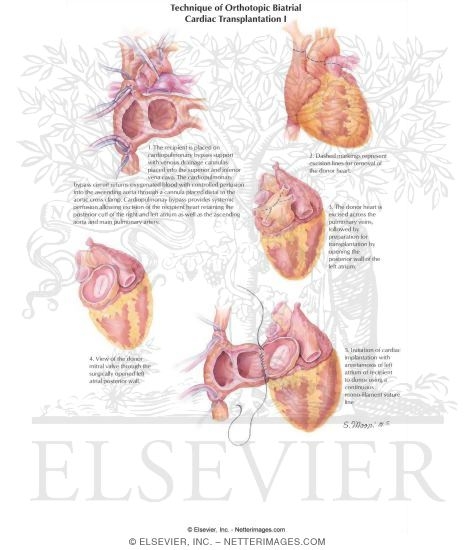Watermarked preview of labeled image: Technique of Orthotopic Biatrial Cardiac Transplantation