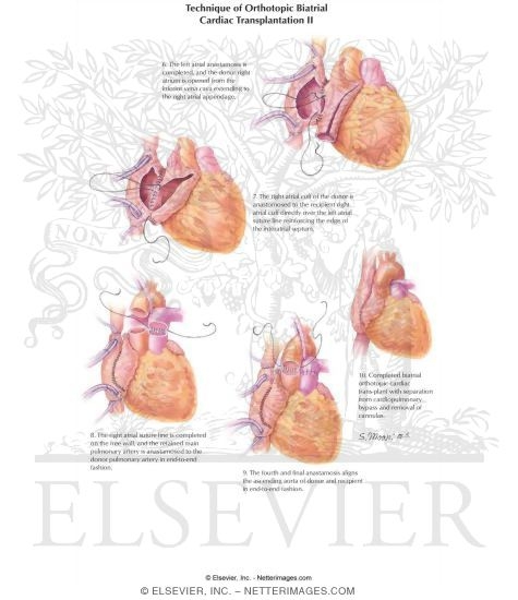Watermarked preview of labeled image: Technique of Orthotopic Biatrial Cardiac Transplantation