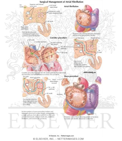 Watermarked preview of labeled image: Surgical Management of Atrial Fibrillation