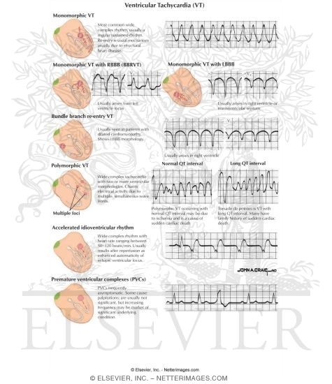 Watermarked preview of labeled image: Ventricular Tachycardia (VT)