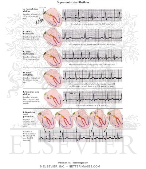 Supraventricular Rhythms