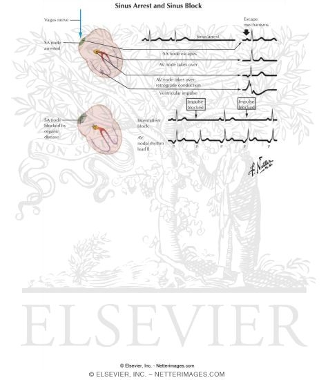 Watermarked preview of labeled image: Sinus Arrest and Sinus Block