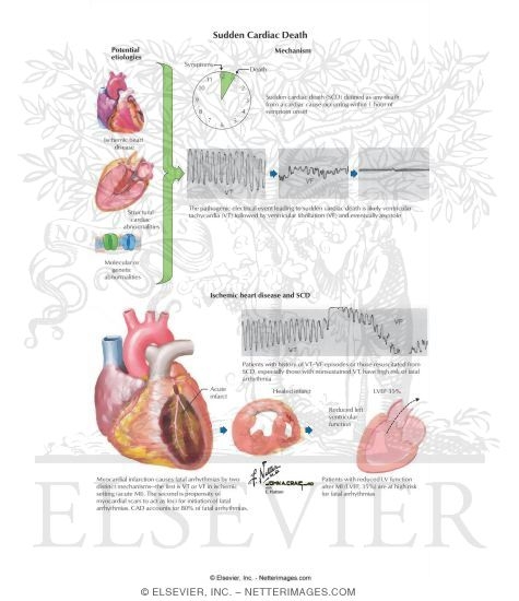 Watermarked preview of labeled image: Sudden Cardiac Death
