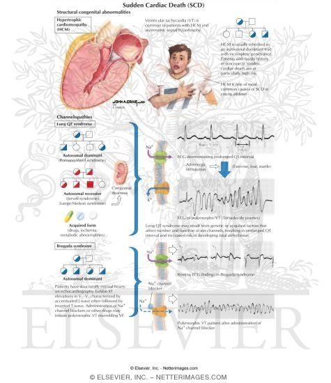 Sudden Cardiac Death