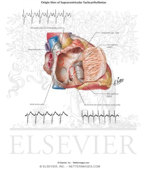 Watermarked preview of labeled image: Origin Sites of Supraventricular Tachyarrhythmias