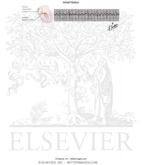 Watermarked preview of labeled image: Atrial Flutter