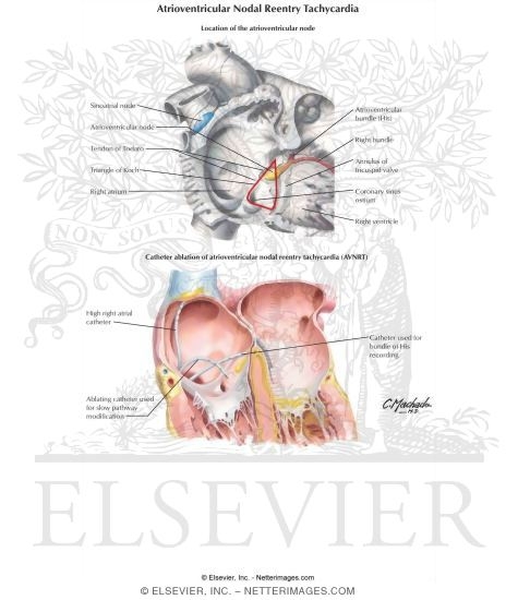 Atrioventricular Nodal Reentry Tachycardia