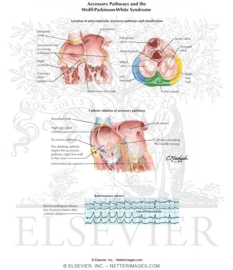 Watermarked preview of labeled image: Accessory Pathways and the Wolff - Parkinson - White Syndrome